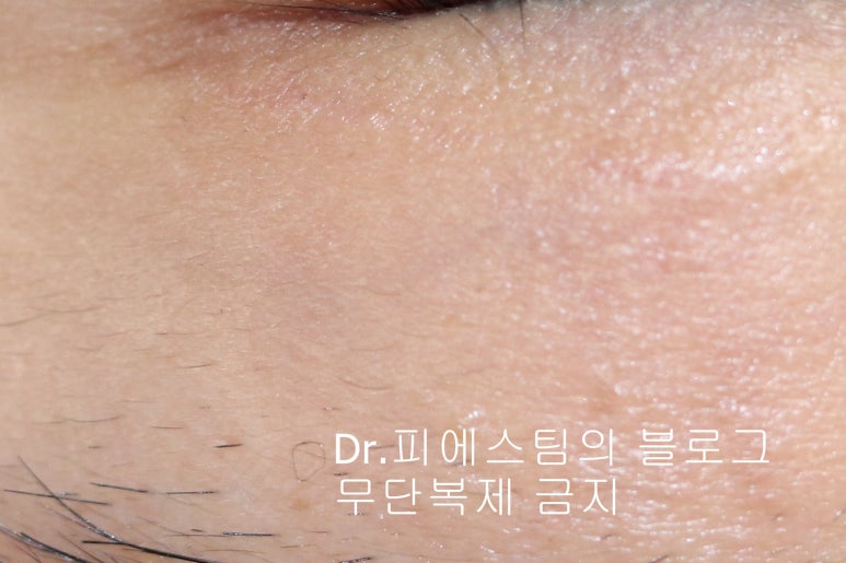 얼굴 찢어진 상처 봉합 성형외과 치료 사례 - 늦어진 상처 편입니다. 관련 이미지 5
