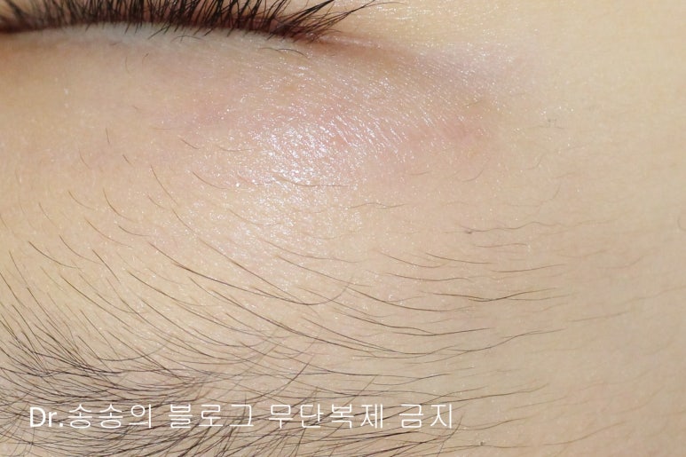 얼굴 상처 봉합 성형외과 치료 사례 - 눈꺼풀 2편 관련 이미지 7