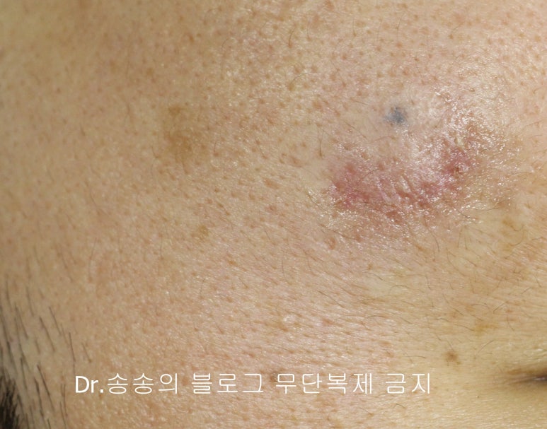 얼굴 찢어진 상처 봉합 성형외과 치료 사례 - 들린 상처 (일명 트랩도어) 편입니다 관련 이미지 9