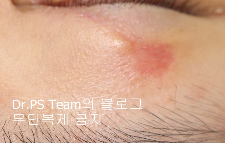 얼굴 찢어진 상처 미세 봉합 & 흉터 레이저 성형외과 치료 사례 - 상안검 편입니다. 관련 이미지 9
