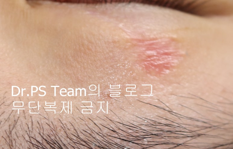 얼굴 찢어진 상처 미세 봉합 & 흉터 레이저 성형외과 치료 사례 - 상안검 편입니다. 관련 이미지 10