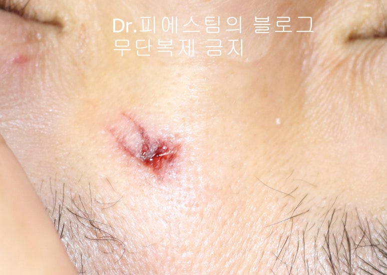 얼굴 찢어진 상처 봉합 성형외과 치료 사례 - 코와 피판에 관하여-1편입니다 관련 이미지 3