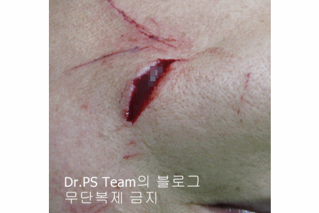 얼굴 찢어진 상처 봉합 & 얼굴 흉터 레이저 성형외과 치료 사례 - 턱 : 긴 상처 편입니다. 관련 이미지 7