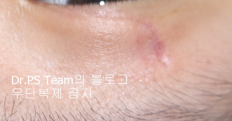 얼굴 찢어진 상처 미세 봉합 & 흉터 레이저 성형외과 치료 사례 - 상안검 편입니다. 관련 이미지 7