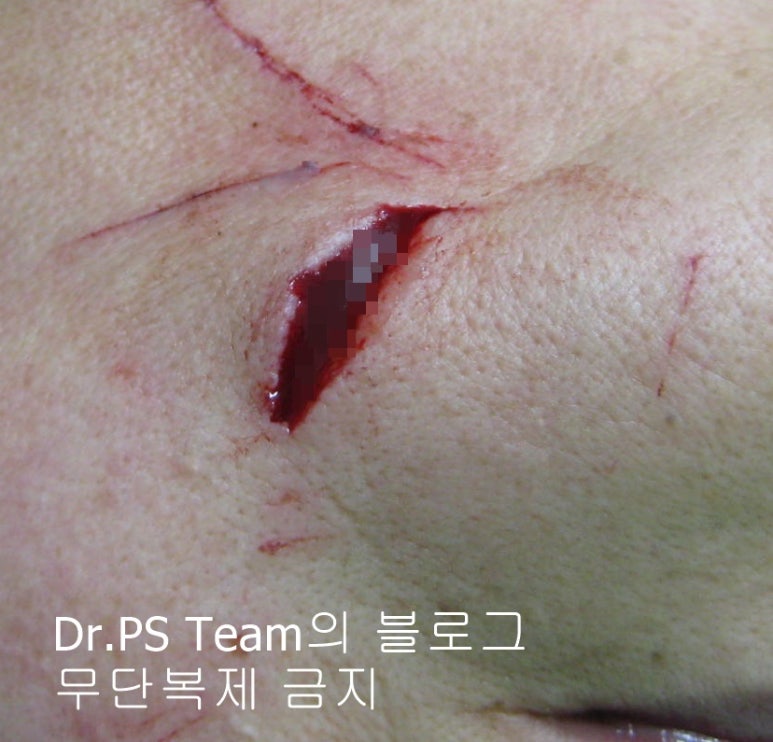 얼굴 찢어진 상처 봉합 & 얼굴 흉터 레이저 성형외과 치료 사례 - 턱 : 긴 상처 편입니다. 관련 이미지 1
