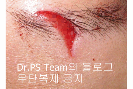 얼굴 찢어진 상처 봉합 성형외과 치료 사례 - 눈썹과 이마 편입니다. 관련 이미지 10