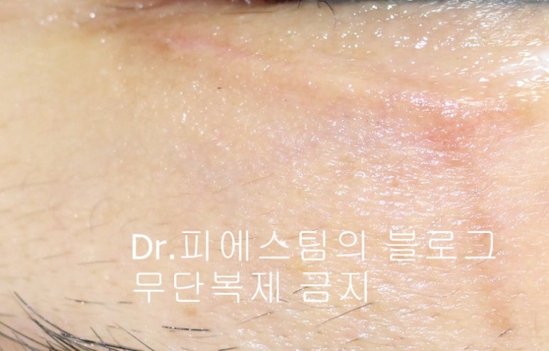 얼굴 찢어진 상처 봉합 성형외과 치료 사례 - 늦어진 상처 편입니다. 관련 이미지 3