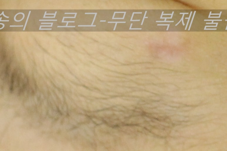 얼굴 상처 봉합 성형외과 치료 사례 - 눈꺼풀 1편 관련 이미지 13