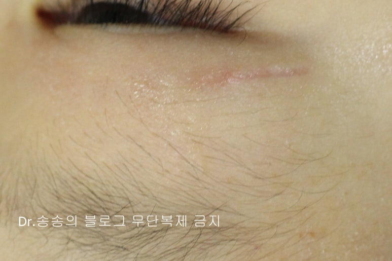 얼굴 상처 봉합 성형외과 치료 사례 - 눈꺼풀 2편 관련 이미지 5