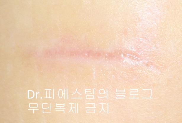 응급실에서 얼굴 상처 일반 봉합 후, 성형외과 레이저 치료 사례 - 뺨 & 이마 (1) 입니다 관련 이미지 3