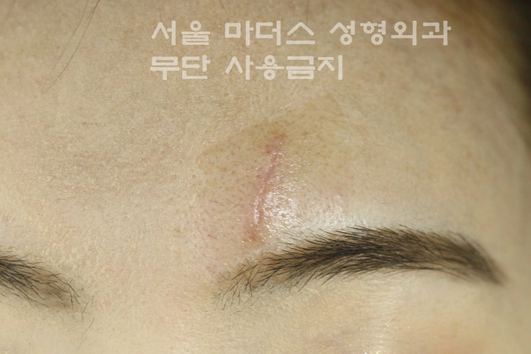 얼굴 상처 봉합 성형외과 - 이마 상처 : 미세 봉합 & 흉터 레이저 관련 이미지 5