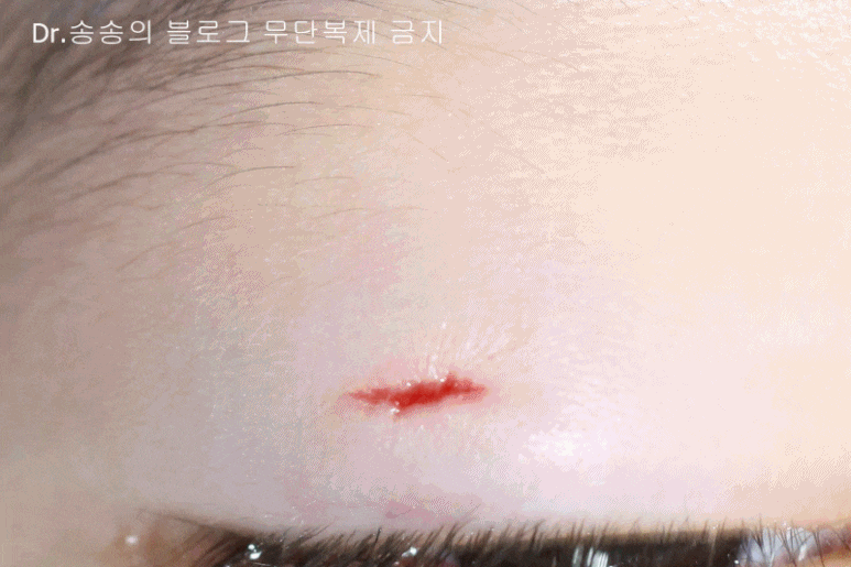 얼굴 상처 봉합 성형외과 치료 사례 - 눈꺼풀 1편 관련 이미지 16