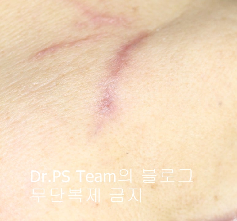 얼굴 찢어진 상처 봉합 & 얼굴 흉터 레이저 성형외과 치료 사례 - 턱 : 긴 상처 편입니다. 관련 이미지 2