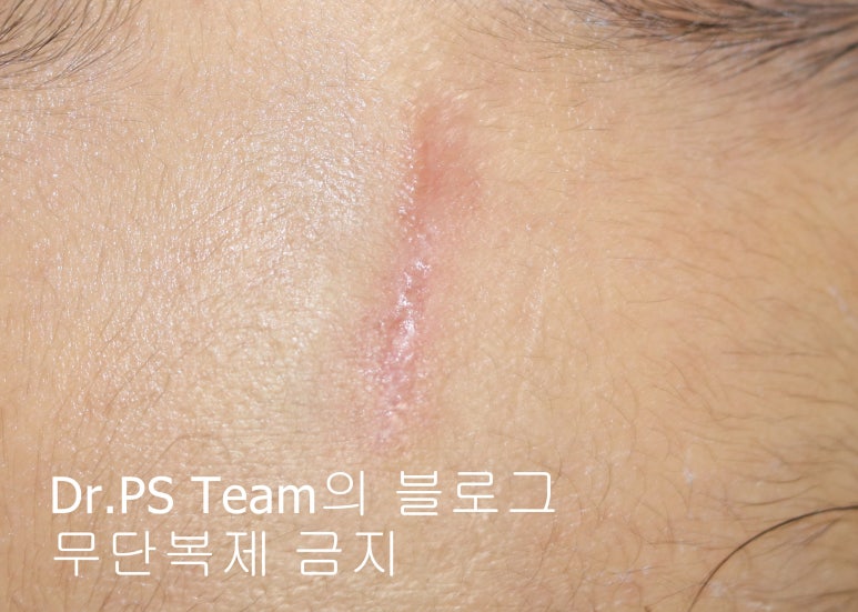 얼굴 찢어진 상처 봉합 & 얼굴 흉터 레이저 성형외과 치료 사례 - 이마 상처 (1) 편입니다. 관련 이미지 5