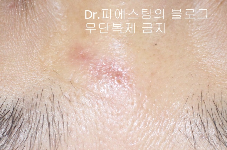 얼굴 찢어진 상처 봉합 성형외과 치료 사례 - 코와 피판에 관하여-1편입니다 관련 이미지 7