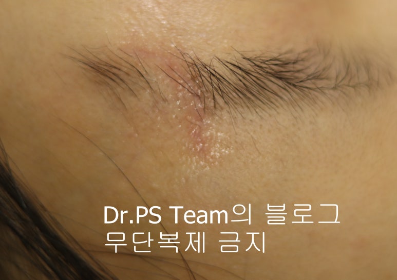 얼굴 찢어진 상처 봉합 성형외과 치료 사례 - 눈썹과 이마 편입니다. 관련 이미지 5