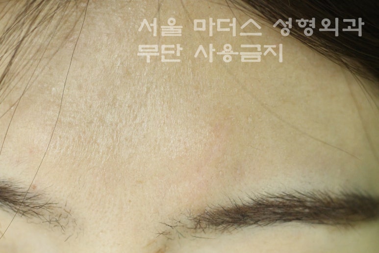 얼굴 상처 봉합 성형외과 - 이마 상처 : 미세 봉합 & 흉터 레이저 관련 이미지 9