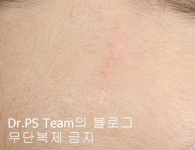 얼굴 찢어진 상처 봉합 & 얼굴 흉터 레이저 성형외과 치료 사례 - 이마 상처 (1) 편입니다. 관련 이미지 7