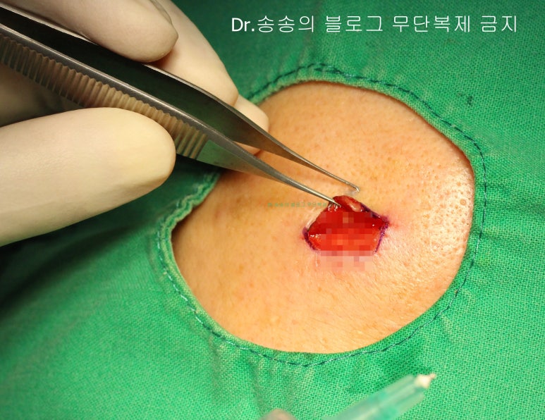 얼굴 찢어진 상처 봉합 성형외과 치료 사례 - 들린 상처 (일명 트랩도어) 편입니다 관련 이미지 8