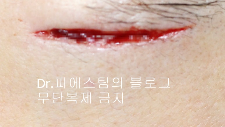 얼굴 찢어진 상처 봉합 성형외과 치료 사례 - 응급실 봉합 vs 성형외과 전문의 미세봉합 편입니다 관련 이미지 6