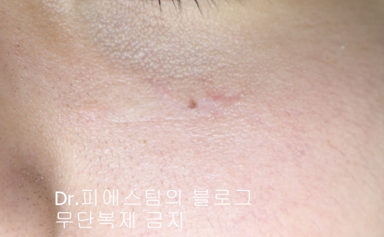 얼굴 찢어진 상처 봉합 성형외과 치료 사례 - 들린 상처: 피판에 관하여 2편입니다 입니다 관련 이미지 12