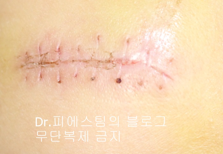 응급실에서 얼굴 상처 일반 봉합 후, 성형외과 레이저 치료 사례 - 뺨 & 이마 (1) 입니다 관련 이미지 1