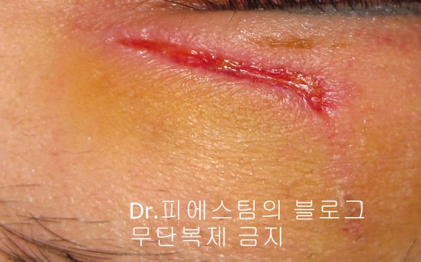 얼굴 찢어진 상처 봉합 성형외과 치료 사례 - 늦어진 상처 편입니다. 관련 이미지 1