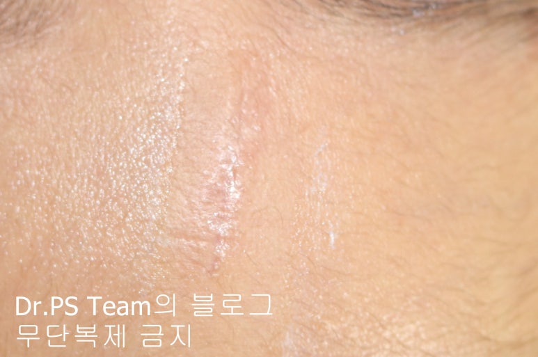 얼굴 찢어진 상처 봉합 & 얼굴 흉터 레이저 성형외과 치료 사례 - 이마 상처 (1) 편입니다. 관련 이미지 4