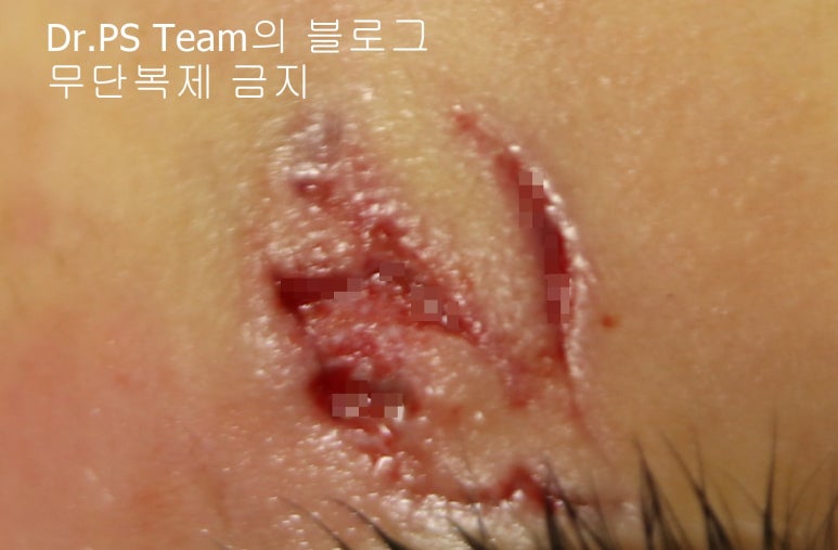 얼굴 찢어진 상처 봉합 & 얼굴 흉터 레이저 성형외과 치료 사례 - 늦어진 상처 봉합 (Delayed wound closure) II - 하안검 편입니다. 관련 이미지 1