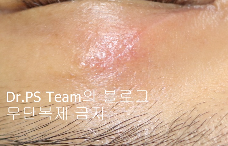 얼굴 찢어진 상처 미세 봉합 & 흉터 레이저 성형외과 치료 사례 - 상안검 편입니다. 관련 이미지 3
