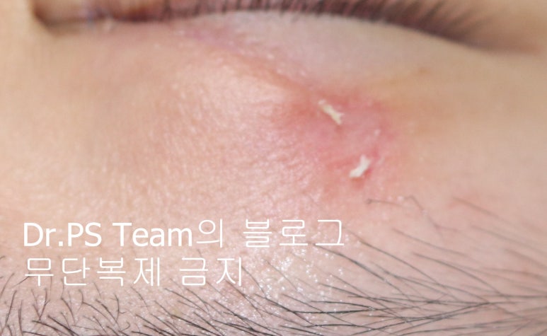 얼굴 찢어진 상처 미세 봉합 & 흉터 레이저 성형외과 치료 사례 - 상안검 편입니다. 관련 이미지 8