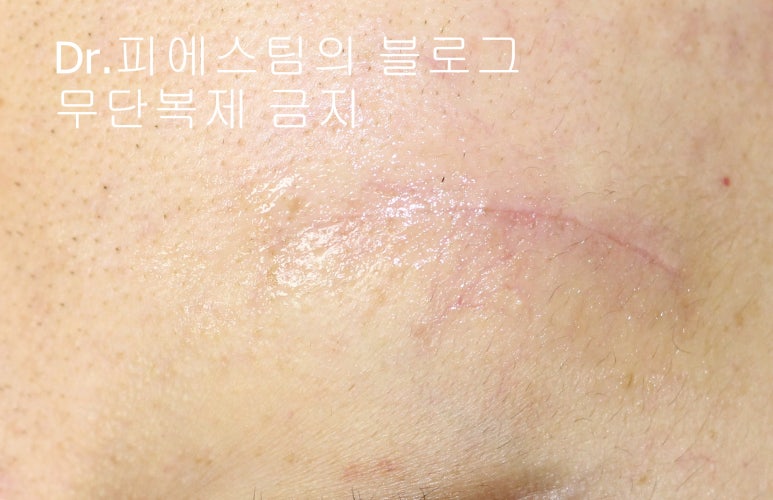 얼굴 찢어진 상처 봉합 성형외과 치료 사례 - 들린 상처: 피판에 관하여 2편입니다 입니다 관련 이미지 4