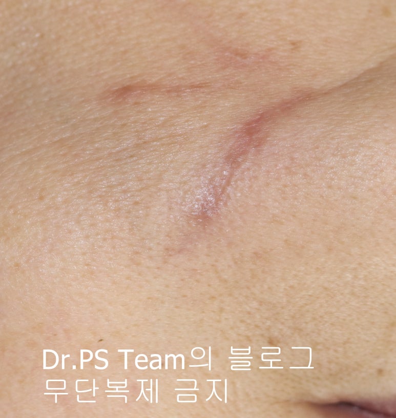 얼굴 찢어진 상처 봉합 & 얼굴 흉터 레이저 성형외과 치료 사례 - 턱 : 긴 상처 편입니다. 관련 이미지 4