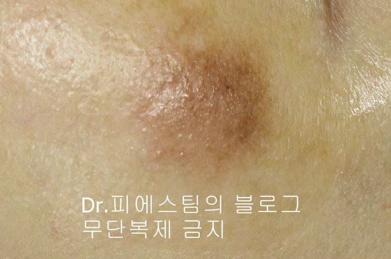 얼굴 상처 봉합 외 표재성 손상, 찰과상의 성형외과 색소침착 치료 사례 - 광대 편입니다 관련 이미지 5