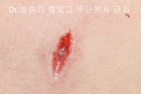 얼굴 상처 봉합 성형외과 치료 사례 - 뺨 1편 관련 이미지 12