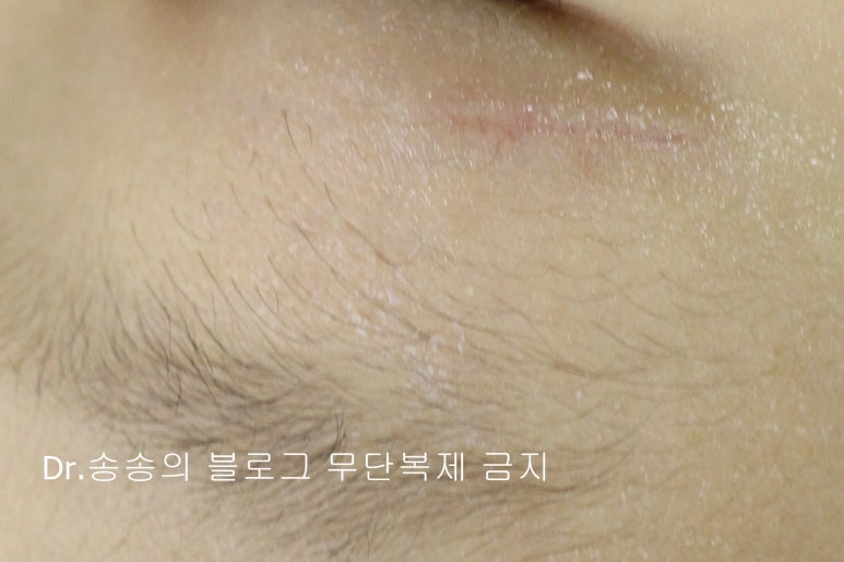 얼굴 상처 봉합 성형외과 치료 사례 - 눈꺼풀 2편 관련 이미지 4