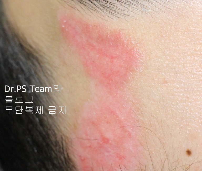 얼굴 찢어진 상처 봉합 & 얼굴 흉터 레이저 성형외과 치료 사례 - 큰 피부 결손 편입니다. 관련 이미지 5
