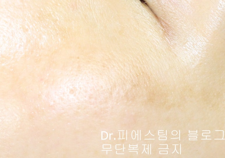 얼굴 상처 봉합 외 표재성 손상, 찰과상의 성형외과 색소침착 치료 사례 - 광대 편입니다 관련 이미지 7