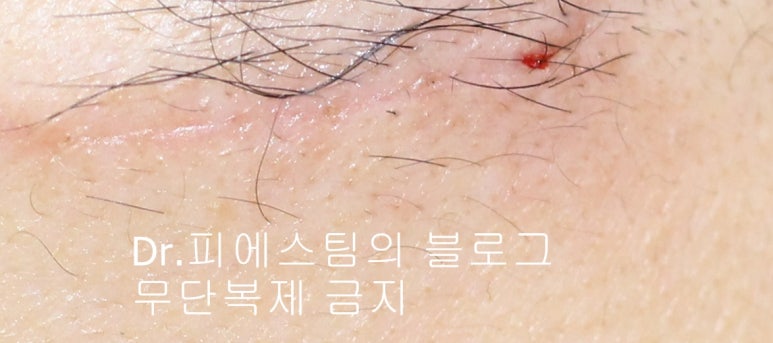 얼굴 찢어진 상처 봉합 성형외과 치료 사례 - 응급실 봉합 vs 성형외과 전문의 미세봉합 편입니다 관련 이미지 8