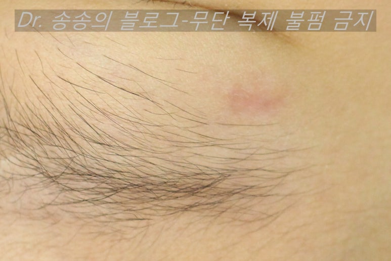 얼굴 상처 봉합 성형외과 치료 사례 - 눈꺼풀 1편 관련 이미지 14