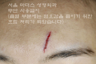 얼굴 상처 봉합 성형외과 - 이마 상처 : 미세 봉합 & 흉터 레이저 관련 이미지 13