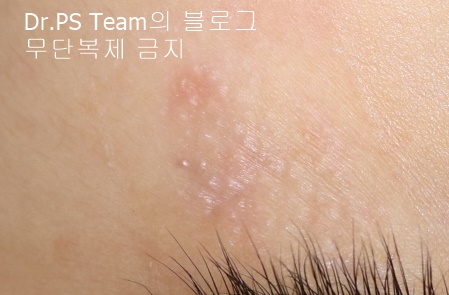 얼굴 찢어진 상처 봉합 & 얼굴 흉터 레이저 성형외과 치료 사례 - 늦어진 상처 봉합 (Delayed wound closure) II - 하안검 편입니다. 관련 이미지 6
