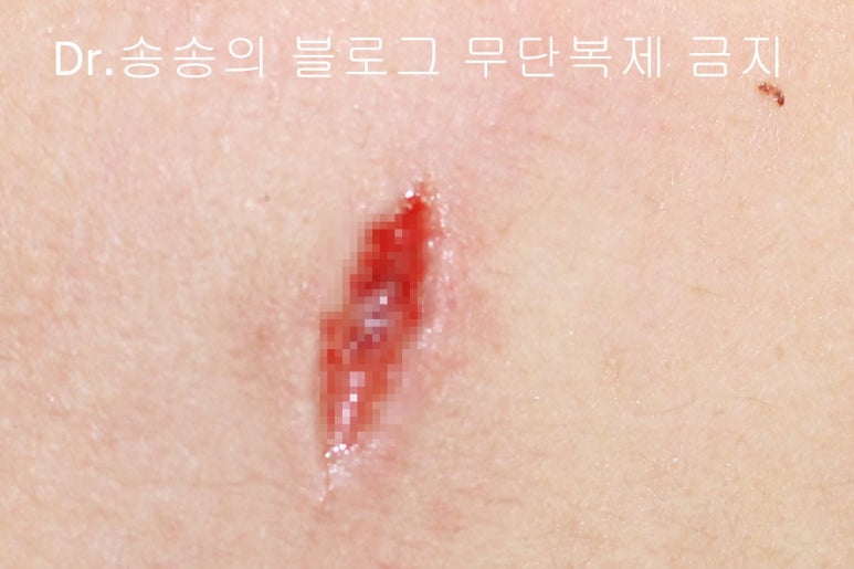 얼굴 상처 봉합 성형외과 치료 사례 - 뺨 1편 관련 이미지 4