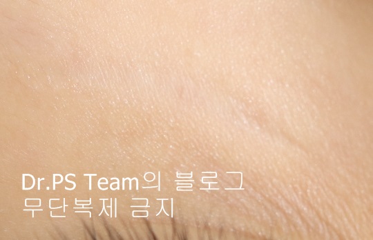 응급실에서 얼굴 상처 일반 봉합 후, 성형외과 흉터 레이저 치료 사례 - 하안검(아래눈꺼풀) 편 입니다 관련 이미지 9