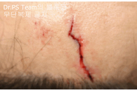 얼굴 찢어진 상처 봉합 & 얼굴 흉터 레이저 성형외과 치료 사례 - 이마 상처 (2) 편입니다. 관련 이미지 8