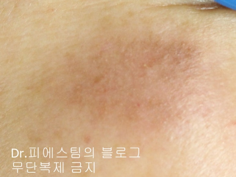 얼굴 상처 봉합 외 표재성 손상, 찰과상의 성형외과 색소침착 치료 사례 - 광대 편입니다 관련 이미지 12