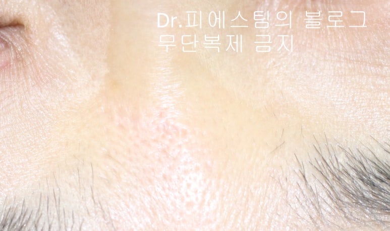 얼굴 찢어진 상처 봉합 성형외과 치료 사례 - 코와 피판에 관하여-1편입니다 관련 이미지 8