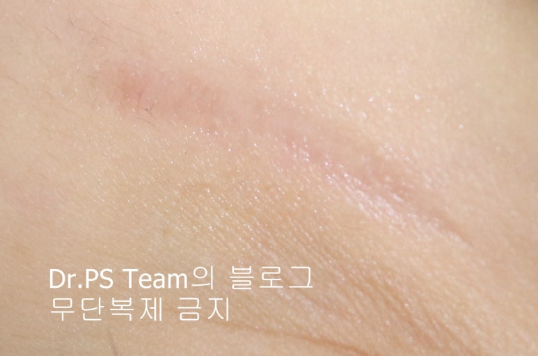 응급실에서 얼굴 상처 일반 봉합 후, 성형외과 흉터 레이저 치료 사례 - 하안검(아래눈꺼풀) 편 입니다 관련 이미지 7