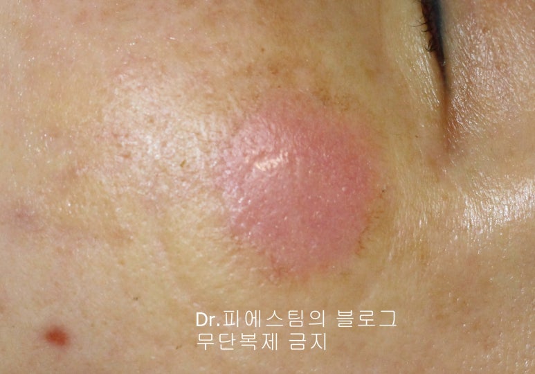 얼굴 상처 봉합 외 표재성 손상, 찰과상의 성형외과 색소침착 치료 사례 - 광대 편입니다 관련 이미지 4