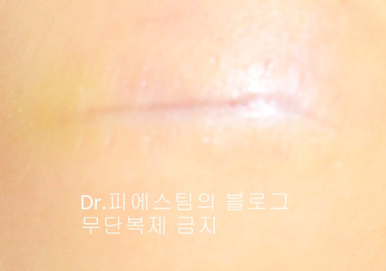 응급실에서 얼굴 상처 일반 봉합 후, 성형외과 레이저 치료 사례 - 뺨 & 이마 (1) 입니다 관련 이미지 2